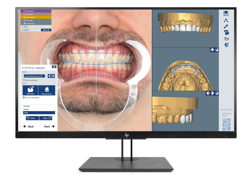 Ceramill M-Smile – Easy, esthetic planning